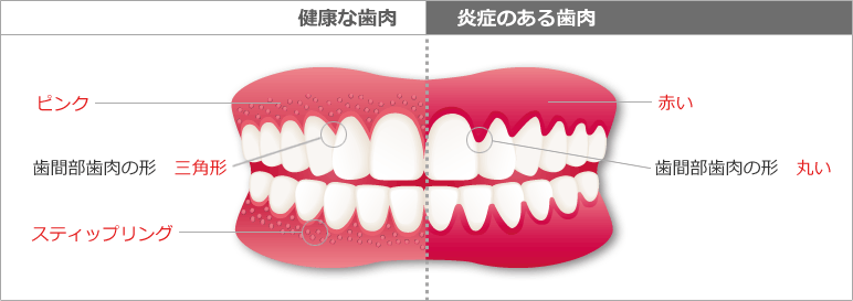 「健康な歯肉」と「炎症のある歯肉の対比図」