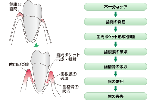 歯周炎の進行状態