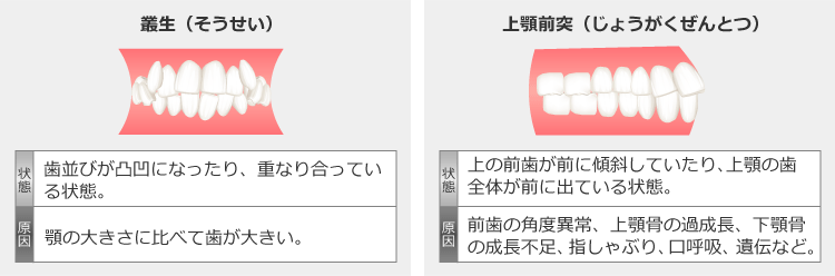 叢生と上顎前突