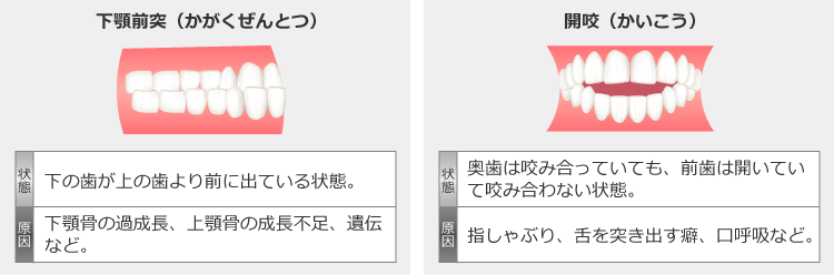 下顎前突と開口