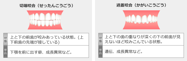 切端咬合と過蓋咬合