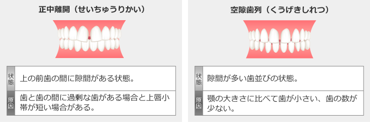 正中離開と空隙歯列