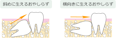 図左：斜めに生えるおやしらず／図右：横向に生えるおやしらず