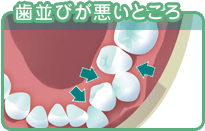 歯並びが悪いところ